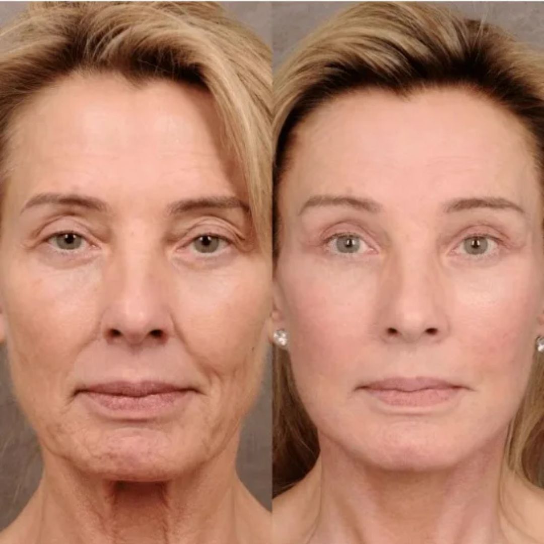 DermaWand® Pro Mesoterapia (Compre e Ganhe 1 Bolsa De Brinde)