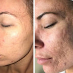 DermaWand® Pro Mesoterapia (Compre e Ganhe 1 Bolsa De Brinde)