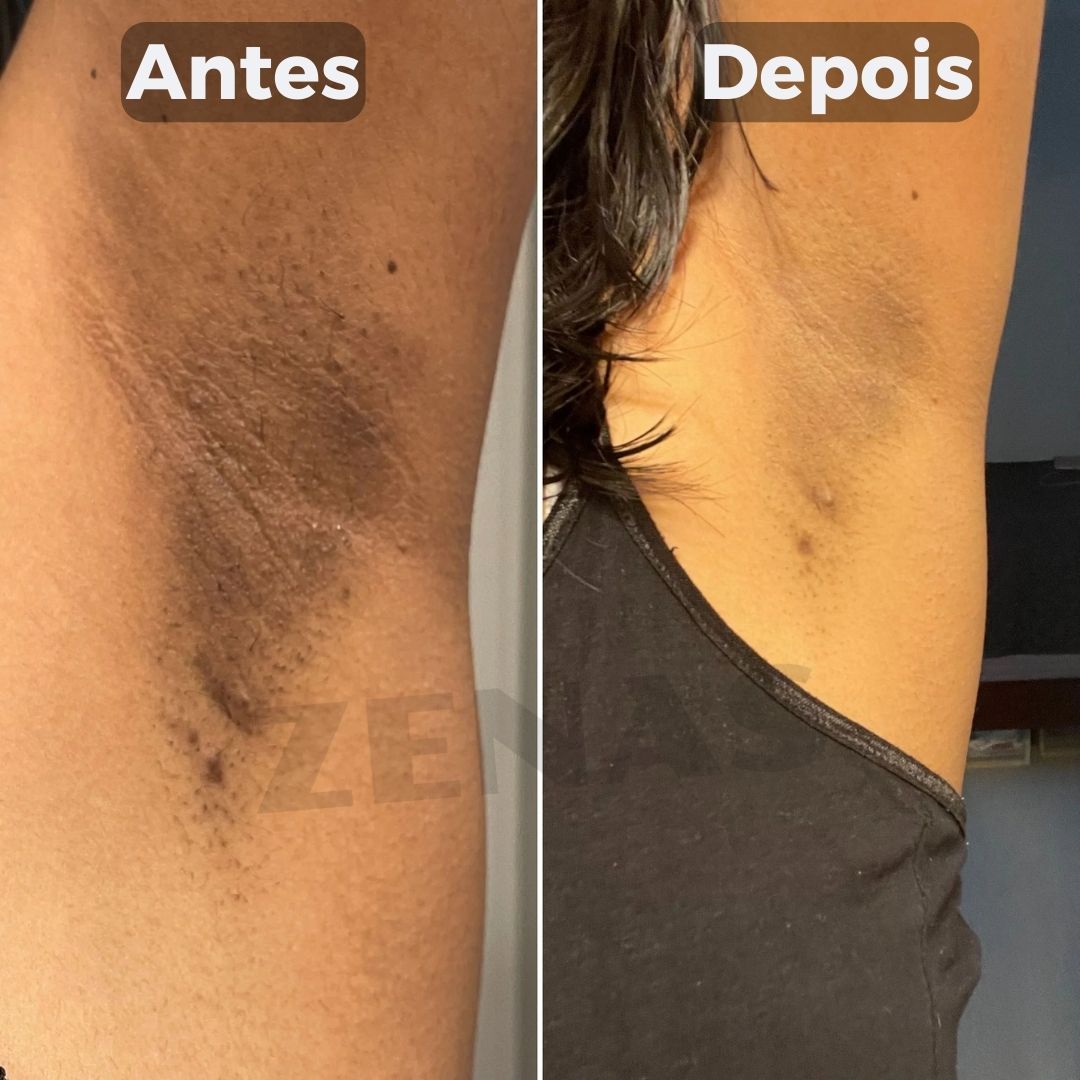 Clareador De Manchas Natural - Amazole™