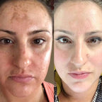 DermaWand® Pro Mesoterapia (Compre e Ganhe 1 Bolsa De Brinde)