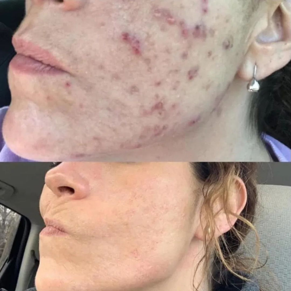 DermaWand® Pro Mesoterapia (Compre e Ganhe 1 Bolsa De Brinde)